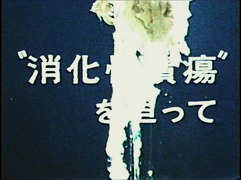 消化性潰瘍を追って