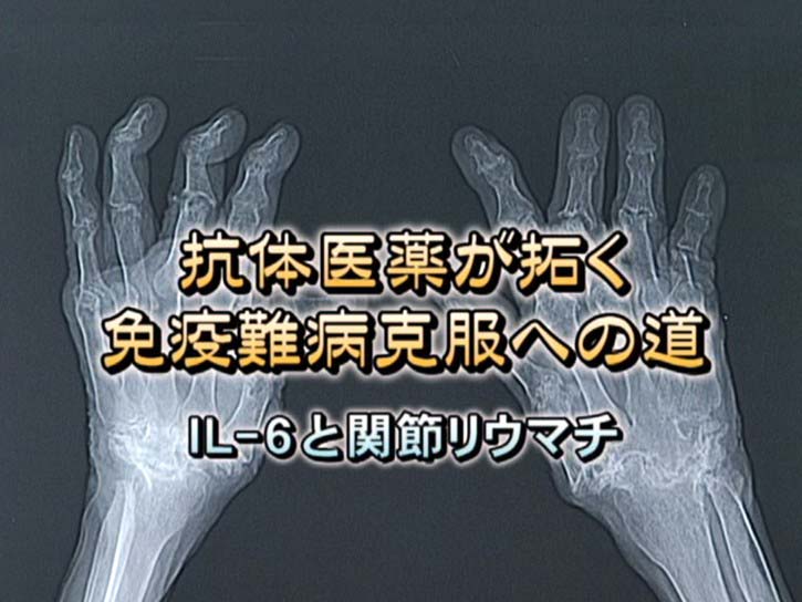 抗体医薬が拓く免疫難病克服への道
IL-6と関節リウマチ